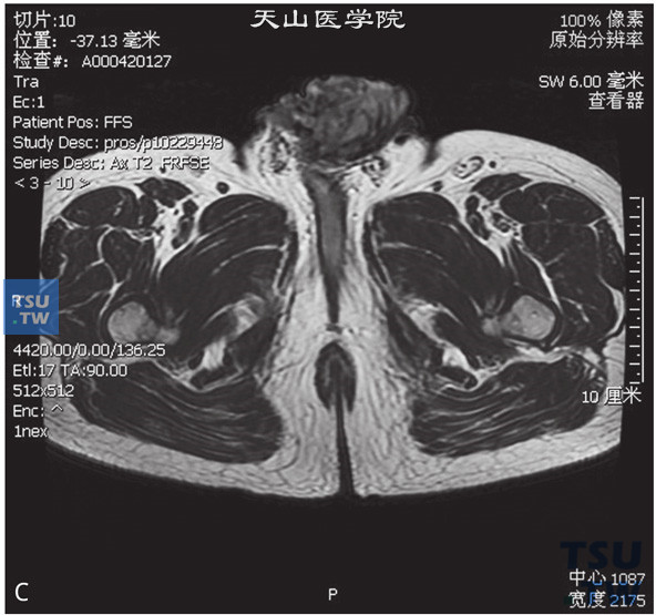 图C：阴茎癌，男，38岁，临床诊断阴茎癌。阴茎见T2WIT1WI等信号灶，DWI呈高信号，增强后明显强化，阴茎正常结构显示不清，冠状位T2WI可见双侧腹股沟多发增大淋巴结聚集成簇