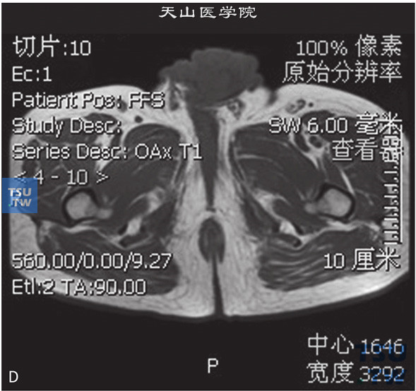 图D：阴茎癌，男，38岁，临床诊断阴茎癌。阴茎见T2WI\T1WI等信号灶，DWI呈高信号，增强后明显强化，阴茎正常结构显示不清，冠状位T2WI可见双侧腹股沟多发增大淋巴结聚集成簇