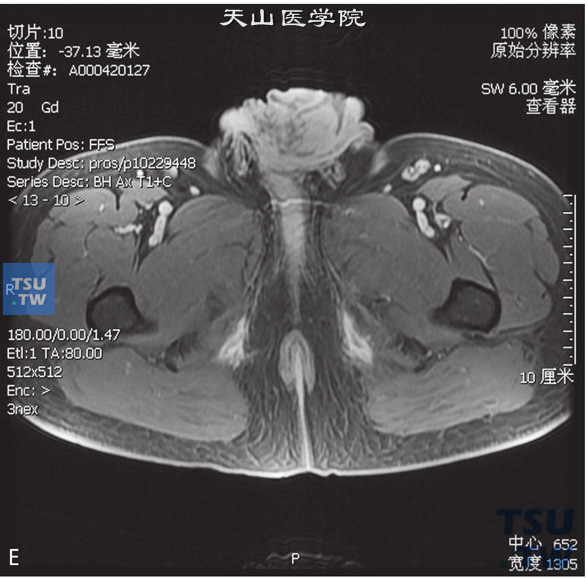 图E：阴茎癌，男，38岁，临床诊断阴茎癌。阴茎见T2WIT1WI等信号灶，DWI呈高信号，增强后明显强化，阴茎正常结构显示不清，冠状位T2WI可见双侧腹股沟多发增大淋巴结聚集成簇