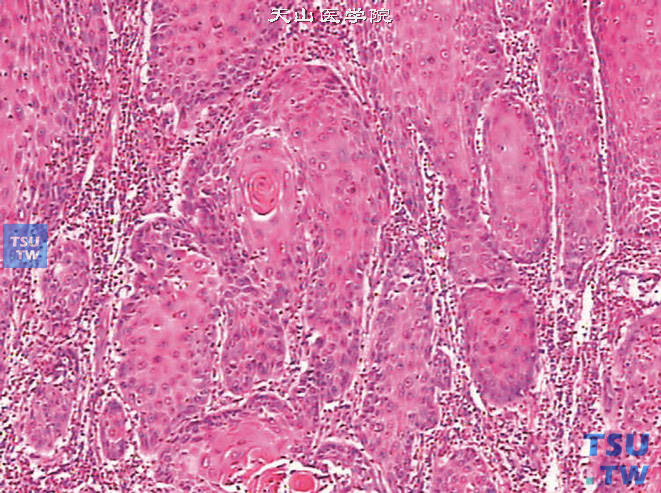 阴茎高分化鳞癌，细胞分化较好，异型性不明显