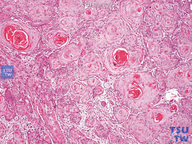 阴茎鳞癌，呈巢状结构，可见角化珠