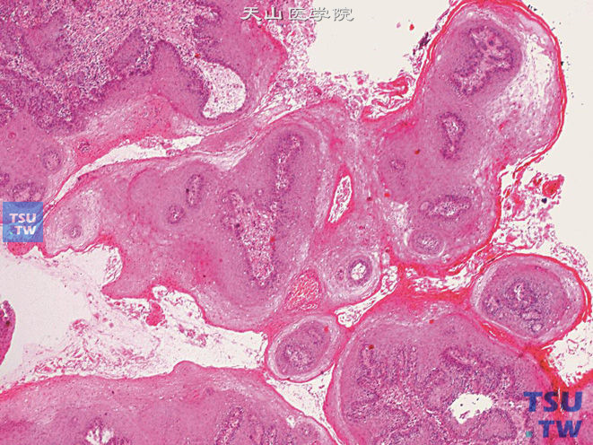 阴茎鳞状上皮低分级乳头状癌，示复杂的乳头状结构及过度角化