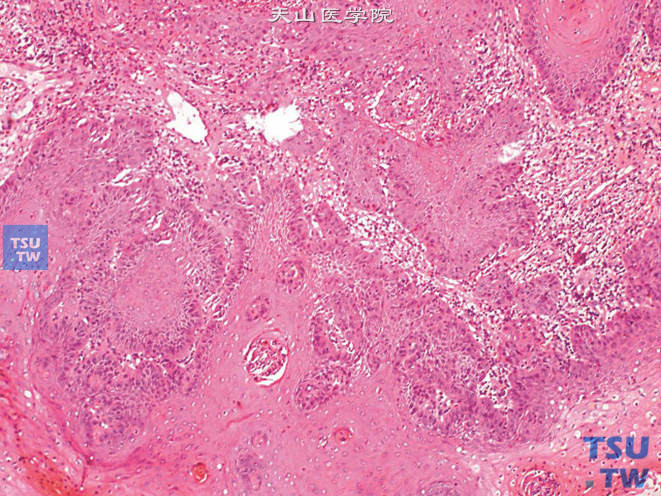 阴茎鳞状上皮低分级乳头状癌，可见不规则浸润下方间质
