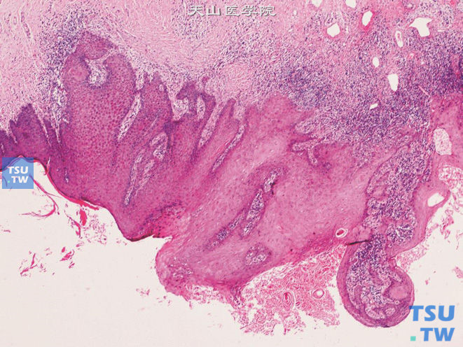 阴茎疣状癌，示角化过度及乳头状结构。纤维血管轴不明显