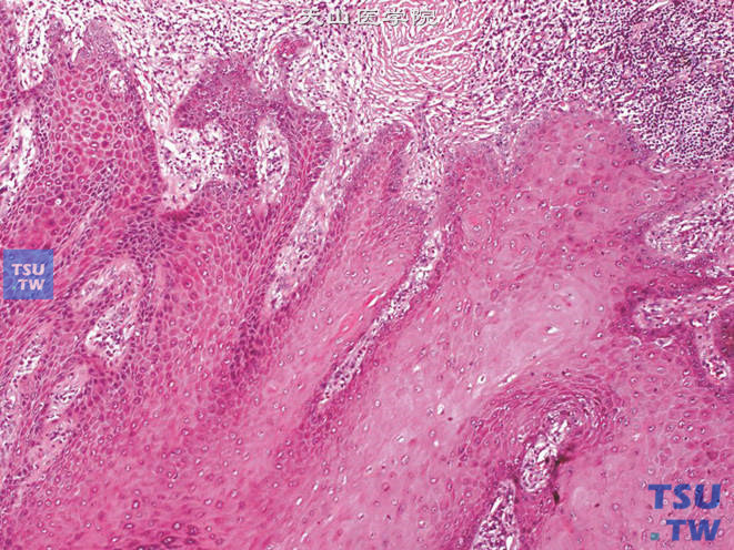 阴茎疣状癌，示细胞核圆形、泡状，染色淡，无挖空细胞。肿瘤向下延伸达间质，但有清楚的基底，压迫周缘组织，难见明确浸润