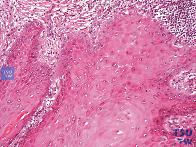 阴茎疣状癌，示小核仁及靠近基底层的异常角化