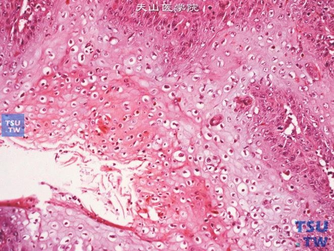 阴茎鳞癌，湿疣样癌变异型。示不典型的挖空细胞