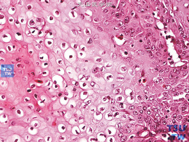 阴茎鳞癌，湿疣样癌变异型。示不典型挖空细胞，核大，深染，可见核皱褶