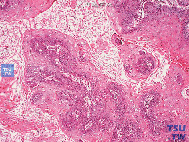 阴茎鳞癌，湿疣样癌变异型。示表层过度角化或角化不全的乳头状瘤样结构