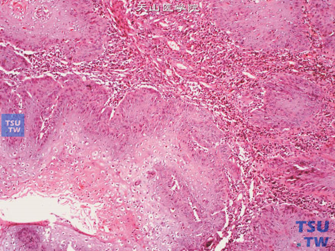 阴茎鳞癌，湿疣样癌变异型。可见浸润性生长及炎细胞浸润