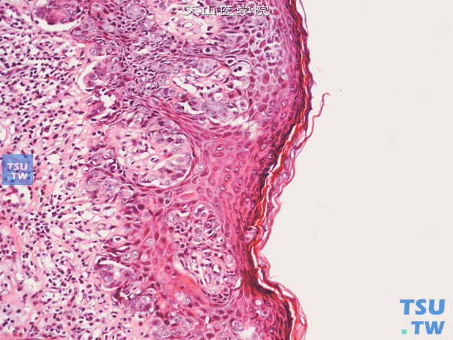 阴茎阴囊Paget病，上图高倍，瘤细胞体积大，胞质色淡或呈空泡状，核大，可见核仁