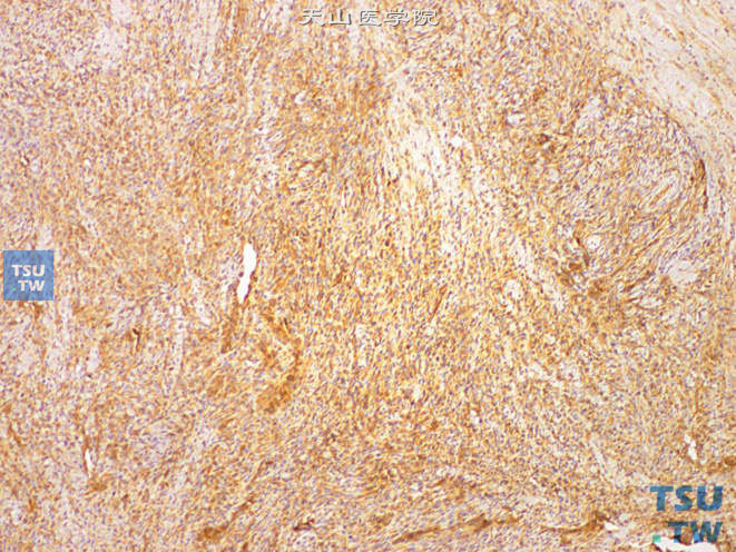 阴茎双相性滑膜肉瘤，免疫组化：CD99（+）
