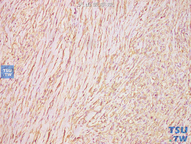 阴茎上皮样肉瘤（普通型），免疫组化：VIM（+）