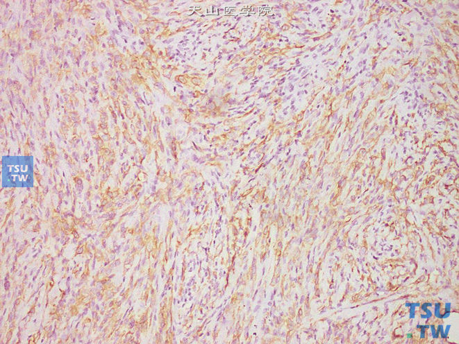 阴茎上皮样肉瘤（普通型），免疫组化：广谱CK（+）
