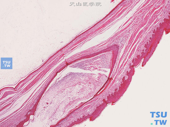 阴囊表皮囊肿，被覆鳞状上皮，腔内可见角化物