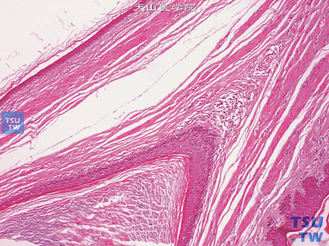 阴囊表皮囊肿，上图高倍，示被覆鳞状上皮，间质可见少量炎细胞浸润