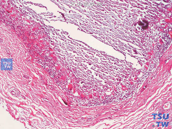阴囊特发性钙质沉着。周围组织伴有明显的异物肉芽肿反应
