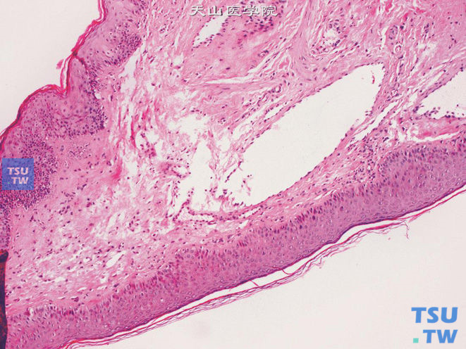 阴囊软纤维瘤。中央为纤维血管性轴心，被覆鳞状上皮