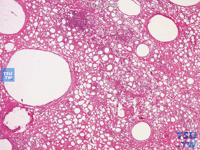 阴囊腺瘤样瘤。瘤组织内可见大小不等的腺腔样结构