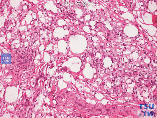 阴囊腺瘤样瘤。上图高倍，示部分瘤细胞胞质呈空泡状
