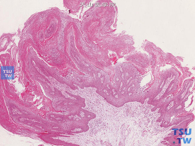 阴囊基底细胞乳头状瘤。基底细胞增生，伴角化过度