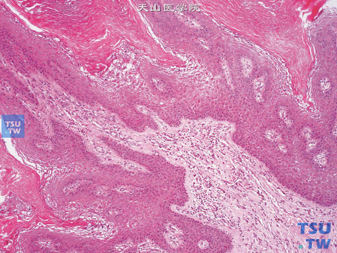 阴囊基底细胞乳头状瘤。上图高倍，示基底细胞增生及角化过度