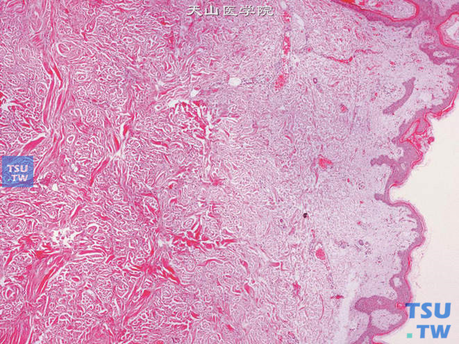 阴囊纤维瘤病。阴囊皮下可见增生的梭形细胞，伴胶原化。无包膜