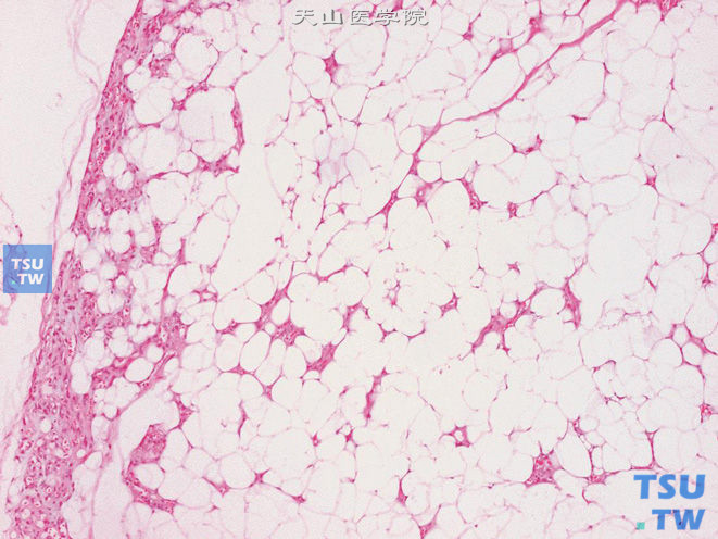 阴囊血管脂肪瘤，包膜菲薄