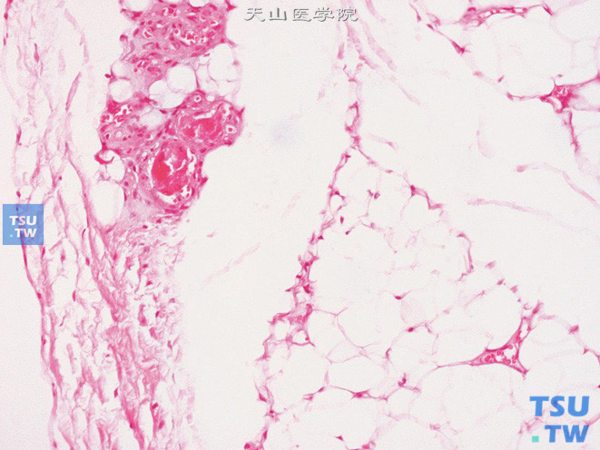 阴囊血管脂肪瘤，示血管内的纤维素血栓