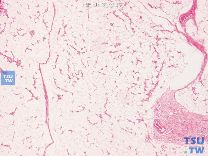 阴囊血管脂肪瘤，由成熟脂肪细胞及有分支的毛细血管构成
