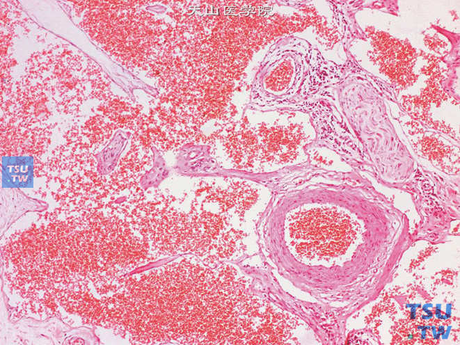 阴囊血管瘤，示部分血管壁菲薄，相互融合