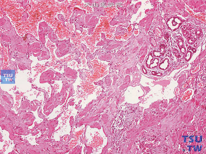 阴囊血管瘤，图示为皮肤附属器周围的相互融合的血管样结构