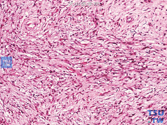 阴囊非典型性脂肪瘤性肿瘤，示部分瘤细胞呈梭形