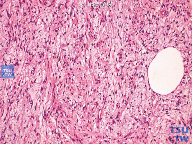 阴囊非典型性脂肪瘤性肿瘤，示胞质内的脂质空泡