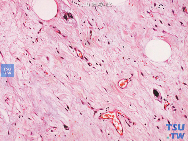 阴囊非典型性脂肪瘤，可见少数异型细胞，高倍
