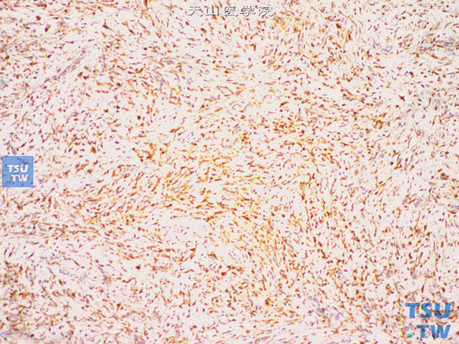 阴囊非典型性脂肪瘤性肿瘤，免疫组化：瘤细胞S-100（+）