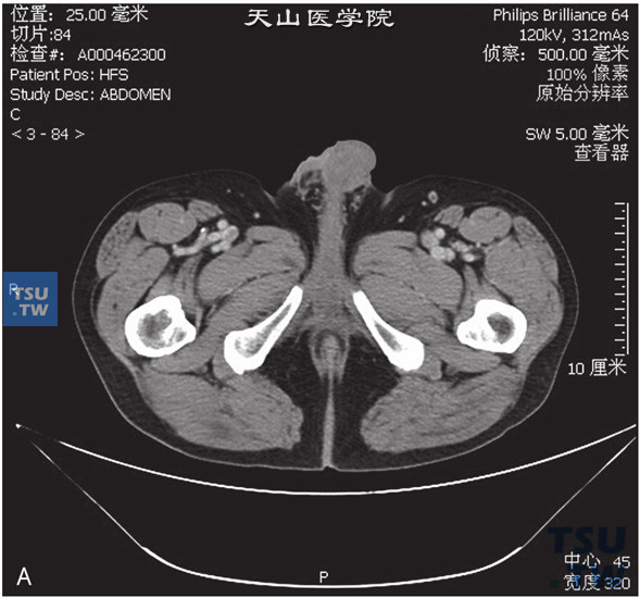 图A：CT，阴囊Paget病，男，63岁，阴茎皮肤增厚。阴茎近右侧阴阜处皮肤明显增厚，增强后可见中度强化