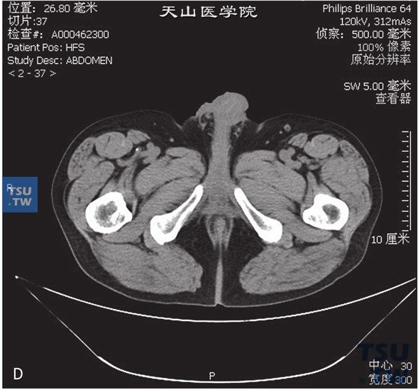 图D：CT，阴囊Paget病，男，63岁，阴茎皮肤增厚。阴茎近右侧阴阜处皮肤明显增厚，增强后可见中度强化