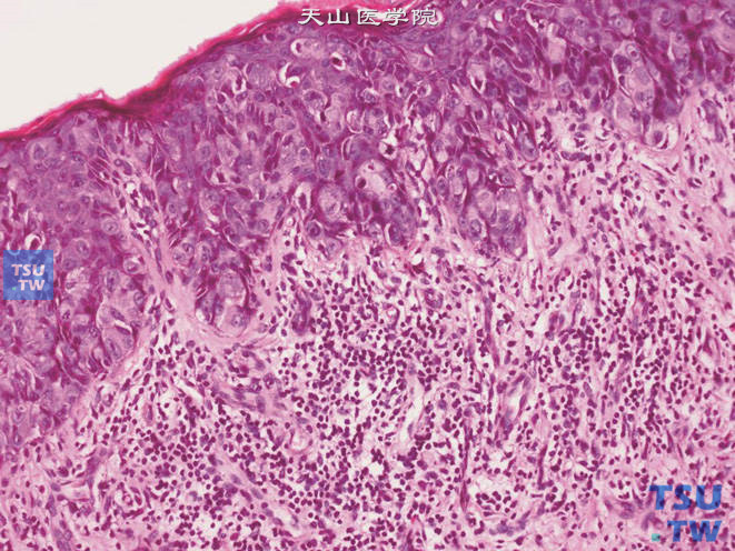 阴囊Paget病，上图高倍，示瘤细胞胞质淡染，核仁明显。位于上皮层内，呈巢状，也可单个存在