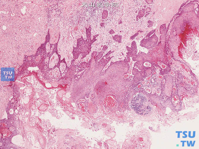 阴囊鳞癌，为高分化鳞癌，表面可有破溃，伴炎细胞浸润