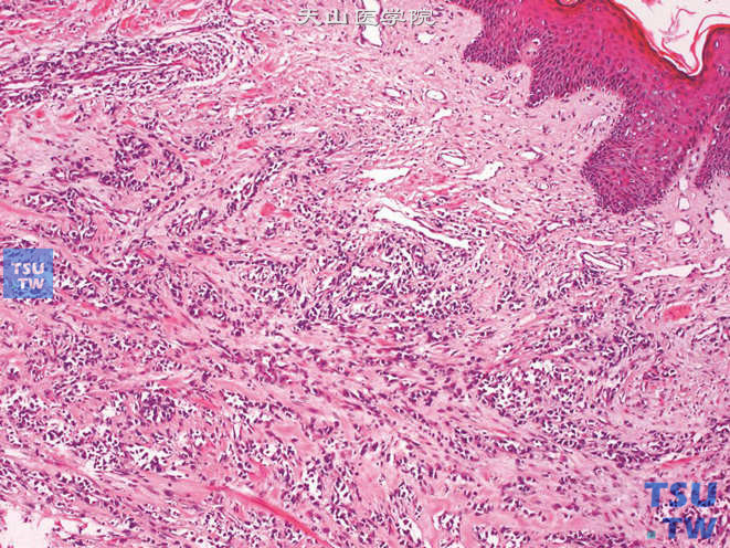 阴囊促纤维组织增生性小圆细胞肿瘤。阴囊上皮下可见小圆细胞浸润，伴纤维组织增生