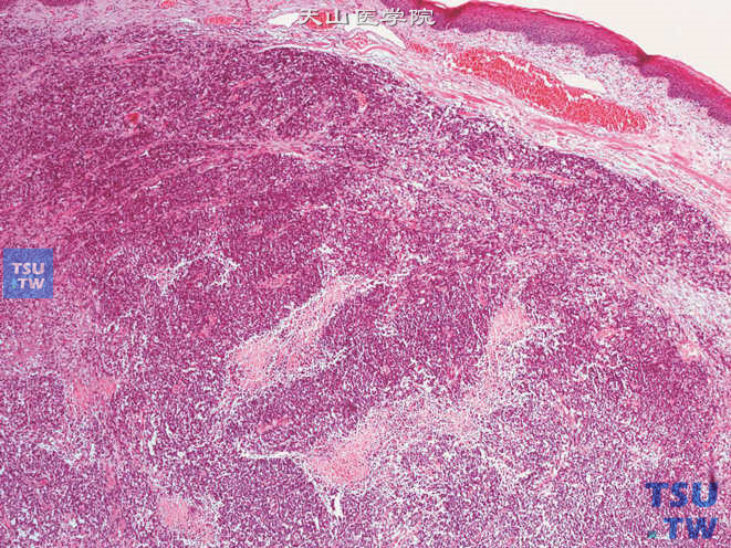 上图高倍,示小圆细胞及增生的纤维组织阴囊低度恶性脂肪肉瘤,部分区域