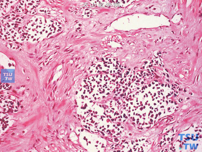 阴囊促纤维组织增生性小圆细胞肿瘤。上图高倍，示小圆细胞及增生的纤维组织