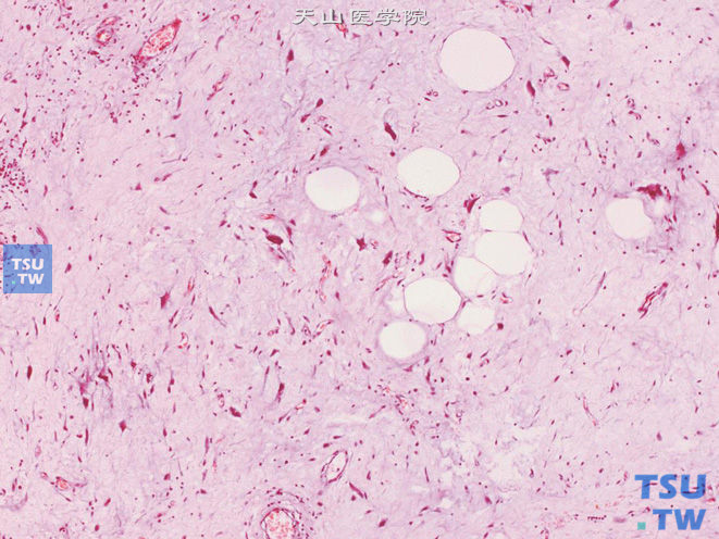 阴囊低度恶性脂肪肉瘤，部分区域可见成熟的脂肪细胞