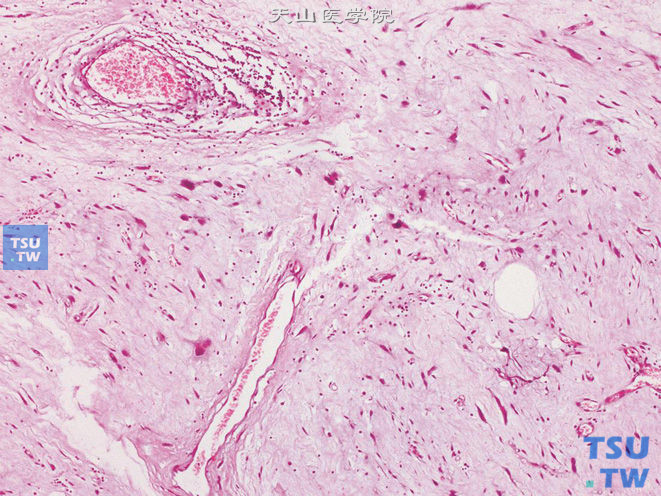 阴囊低度恶性脂肪肉瘤，示局部细胞异型性明显