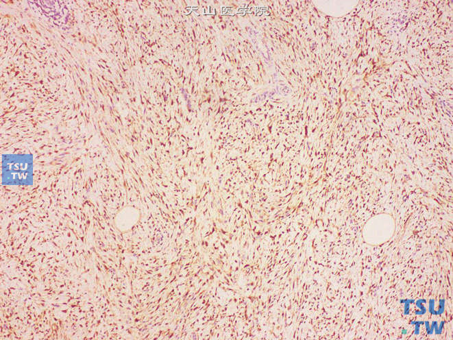 阴囊低度恶性脂肪肉瘤，免疫组化：S-100（+）