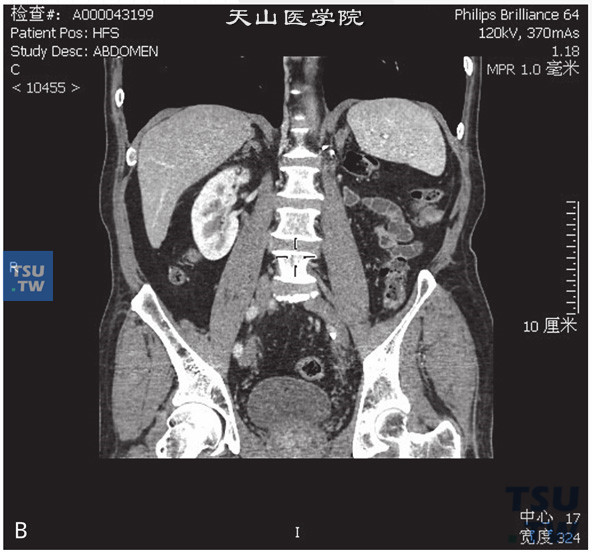 图B：CT，肾上腺增生，男，55岁，体检。左侧肾上腺体积增大，边缘光整，增强后未见异常强化