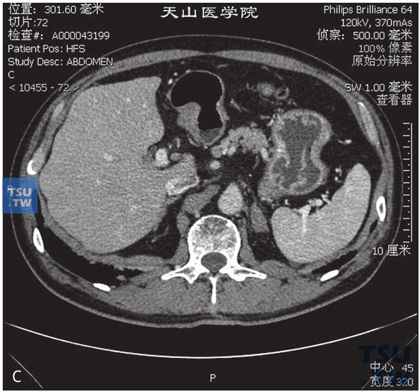 图C：CT，肾上腺增生，男，55岁，体检。左侧肾上腺体积增大，边缘光整，增强后未见异常强化