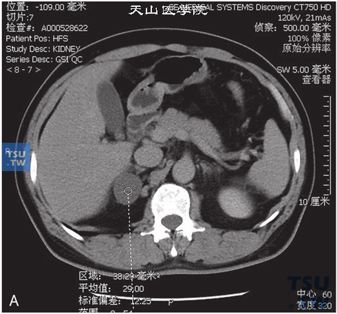 图A：CT，肾上腺皮质腺瘤，女，38岁，高血压。右侧肾上腺内肢见一类圆形低密度灶，边缘清晰，平扫CT值为9HU，增强后动脉期及延时期CT值分别为42HU与37HU