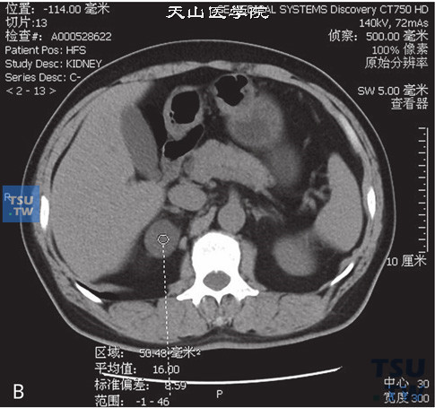 图B：CT，肾上腺皮质腺瘤，女，38岁，高血压。右侧肾上腺内肢见一类圆形低密度灶，边缘清晰，平扫CT值为9HU，增强后动脉期及延时期CT值分别为42HU与37HU
